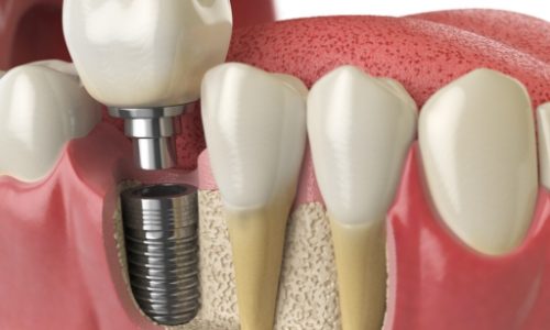 dental implant petrie