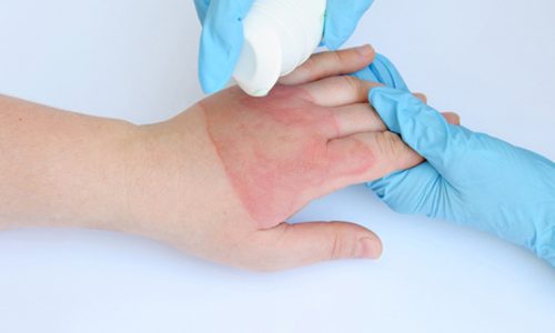 Top Causes Of Burn Injuries